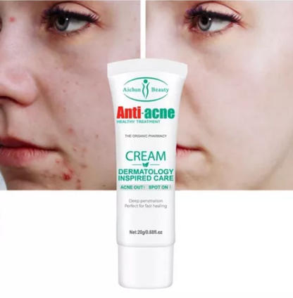 CREMA ANTI ACNE